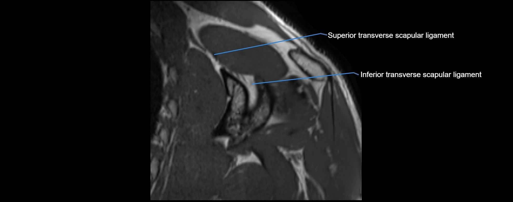 shoulder ligments coronal  cross sectional anatomy 3T MRI AI enhanced radiology image -img-00001-00036.webp